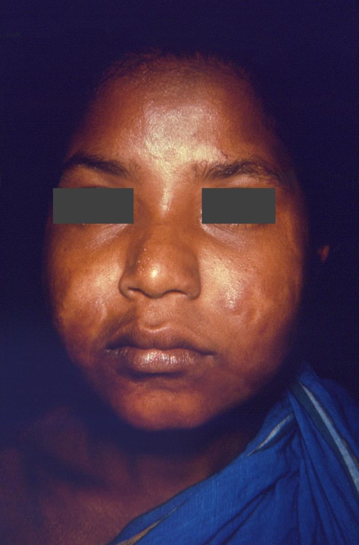 Borderline, or dimorphous leprosy with bilateral involvement of the buccinator muscles, as well as dermatomyositis. Adapted from Public Health Image Library (PHIL), Centers for Disease Control and Prevention.[6]