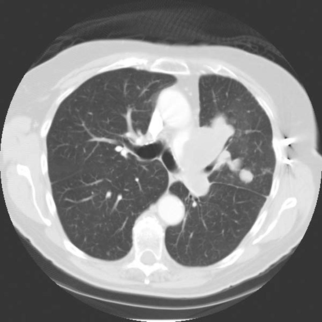 CT Pulmonary angiosarcoma Courtesy of Radiopedia