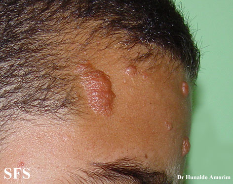 Tuberous sclerosis. Adapted from Dermatology Atlas.[1]