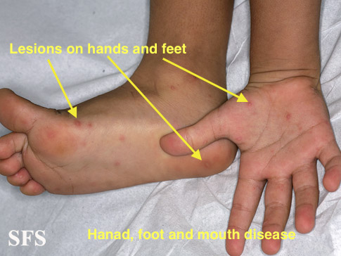 File:Hand foot mouth disease-1.jpg