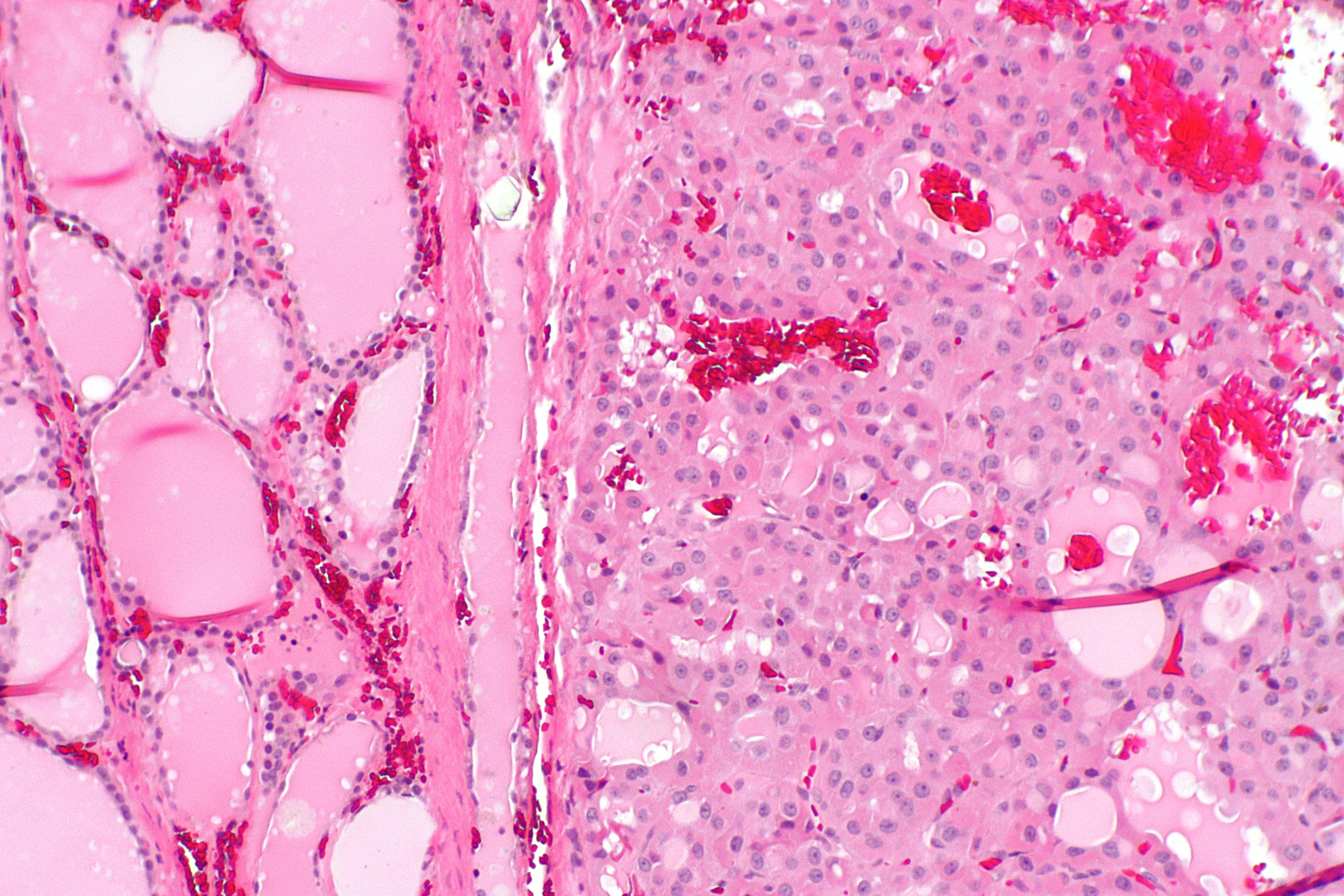 File:Papillary thyroid carcinoma oncocytic variant -- low mag.jpg