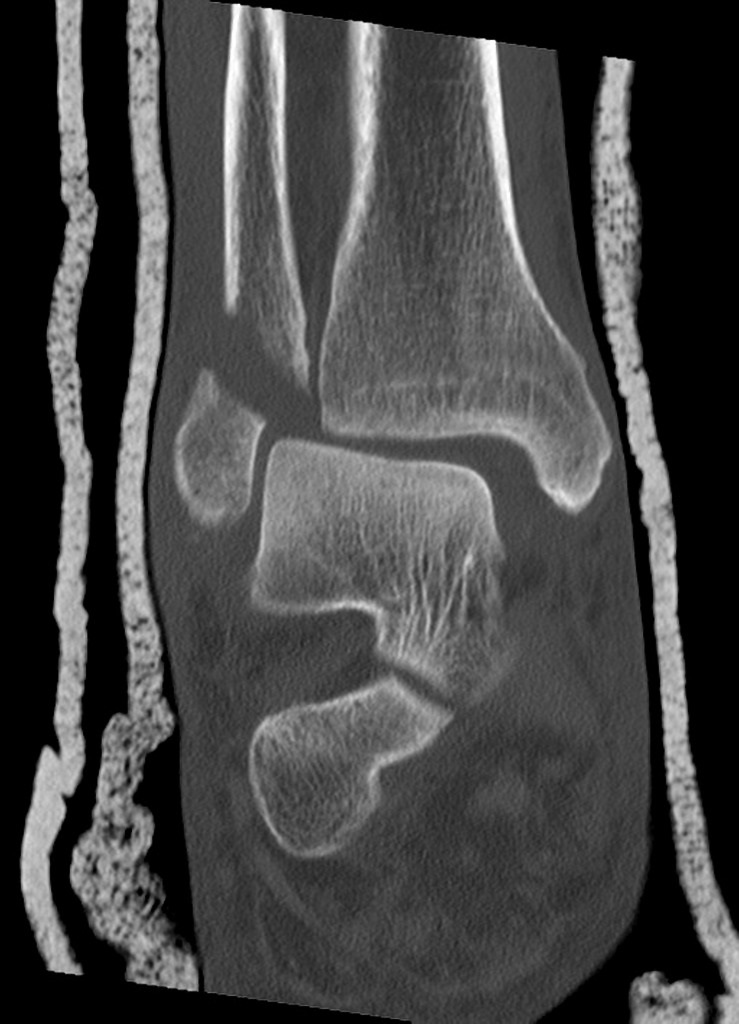 Coronal bone window Displaced distal fibular fracture with mild posterior angulation/ displacement. Comminuted and moderately displaced posterior malleolus fracture with a large articular surface step. Medial malleolus avulsion fracture involving the deltoid ligament. Anterior subluxation of the tibia on the talus also with lateral talar shift. Associated soft tissue swelling.