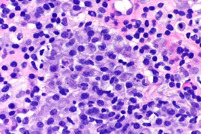 Multiple myeloma slide with high magnification[23]