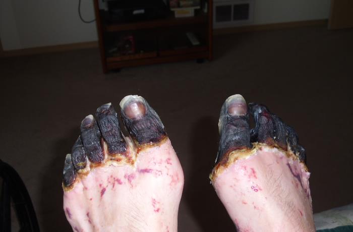 Dorsal view of a 59 year-old man’s feet who had been infected by the plague bacterium, Yersinia pestis, after having come into contact with both an infected cat, and a dead mouse in his neighborhood. Adapted from Public Health Image Library (PHIL), Centers for Disease Control and Prevention.[15]