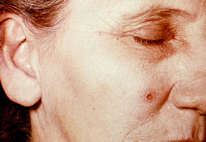"Anthrax, skin of face, 4th day”Adapted from Public Health Image Library (PHIL), Centers for Disease Control and Prevention.[20]