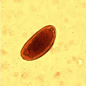 Egg of E. vermicularis in an iodine-stained wet mount from a formalin concentrate. Image contributed by the Kansas State Public Health Laboratory. Adapted from CDC
