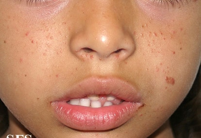 Tuberous sclerosis. Adapted from Dermatology Atlas.[1]