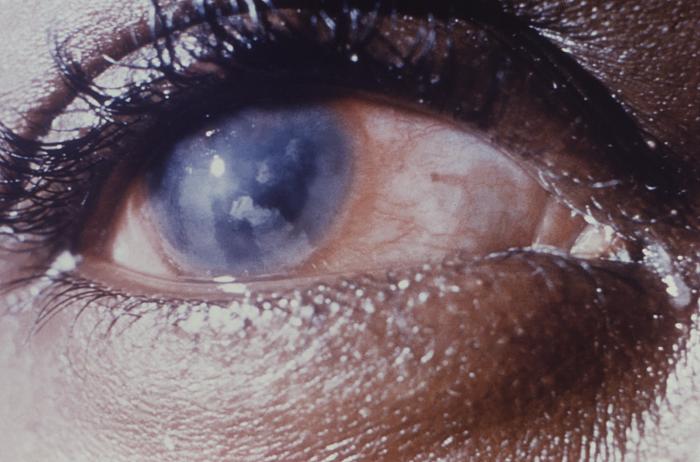 This image depicts a close view of the right eye of a patient revealing the pathologic changes in her cornea known as interstitial corneal keratitis, which was due to a congenital syphilitic infection, and is a chronic progressive keratitis of the corneal stroma, i.e., connective tissue matrix, often resulting in blindness and frequently associated with congenital syphilis. Congenital syphilis, is a condition caused by infection in utero with Treponema pallidum. A wide spectrum of severity exists, and only severe cases are clinically apparent at birth. An infant or child (aged less than 2 years) may have signs such as hepatosplenomegaly, rash, condyloma lata, snuffles, jaundice (nonviral hepatitis), pseudoparalysis, anemia, or edema (nephrotic syndrome and/or malnutrition). An older child may have stigmata (e.g., interstitial keratitis, nerve deafness, anterior bowing of shins, frontal bossing, mulberry molars, Hutchinson teeth, saddle nose, rhagades, or Clutton joints). Adapted from CDC