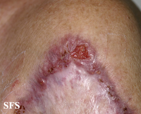 Lupus vulgaris. Adapted from Dermatology Atlas.[5]