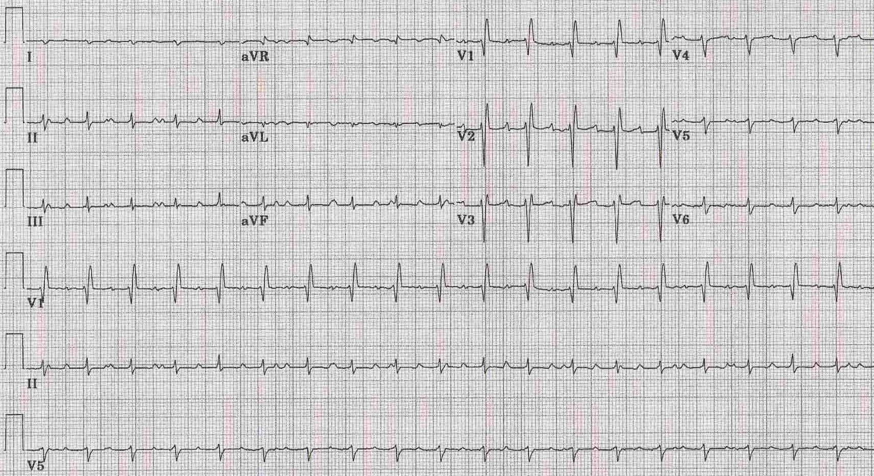 12 lead EKG shows accessory atrial activity (better seen in lead II at the end of the first complex in the middle between the second and third complex and after the third complex) due to some of the original sinus node still remains in addition to the donor sinus node after a cardiac transplant. Because of a suture line in the right atrium the ectopic atrial rhythm rarely conducts to the AV node. Right axis deviation and a rSR' which might suggest volume overload RVH also shown.