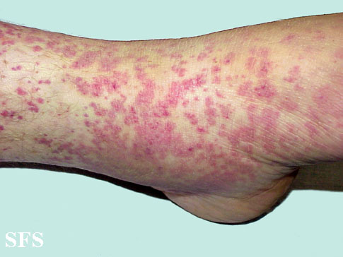 File:Allergic vasculitis 05.jpeg