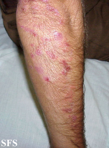 Dermatitis herpetiformis. Adapted from Dermatology Atlas.[1]