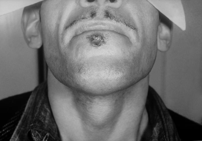 A photograph of a primary syphilitic chancre of the lower lip due to Treponema pallidum bacteria. A patient with a typical syphilitic chancre located on lower lip. A chancre is a small, painless red ulcer that develops during primary syphilis. Primary syphilis is characterized by one or more chancres after inoculation with T. pallidum bacteria. Adapted from CDC