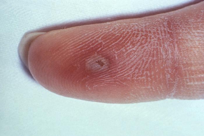 This 1970 photograph revealed the presence of what was determined to be a secondary gonococcal lesion located on the distal finger tip of a patient who presented with a case of gonorrhea. Usually, secondary gonococcal lesions manifest themselves when a primary infection of the urogenital tract becomes disseminated throughout the body by way of the circulatory system. Adapted from CDC