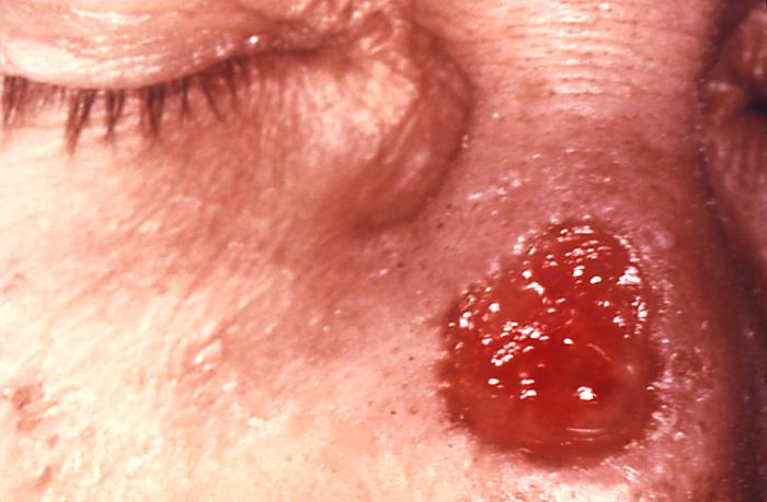 This patient presented with a gumma of nose due to a long standing tertiary syphilitic Treponema palliduminfection. Without treatment, an infected person still has syphilis even though there are no signs or symptoms. It remains in the body, and it may begin to damage the internal organs, including the brain, nerves, eyes, heart, blood vessels, liver, bones, and joints. Adapted from CDC