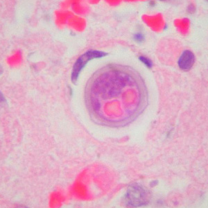 Cyst of B. mandrillaris in brain tissue, stained with H&E. Image courtesy of Cook Children’s Hospital, Fort Worth, Texas. Adapted from CDC