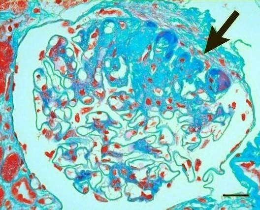 File:Histopathology of secondary segmental glomerular sclerosis of hypertensive nephropathy.jpg