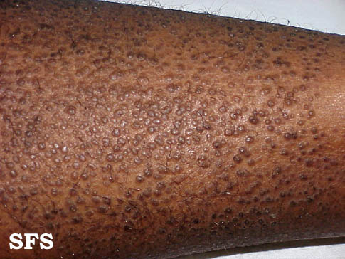 .Lichen amyloidosus Adapted from Dermatology Atlas.[5]