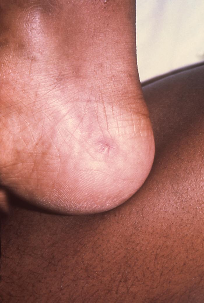 The lesion on this patient’s heel was due to the systemic dissemination of the N. gonorrhoeae bacteria. Gonorrhea is the most frequently reported communicable disease in the U.S. Disseminated gonococcal infection is most often the cause of acute septic arthritis in sexually active adults, and the reason for most hospitalizations due to infective arthritis. Adapted from CDC