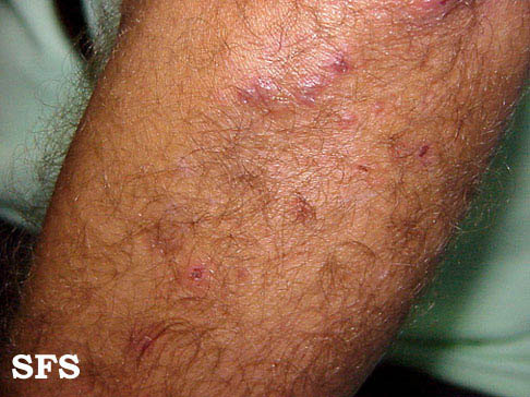 File:Dermatitis herpetiformis09.jpg