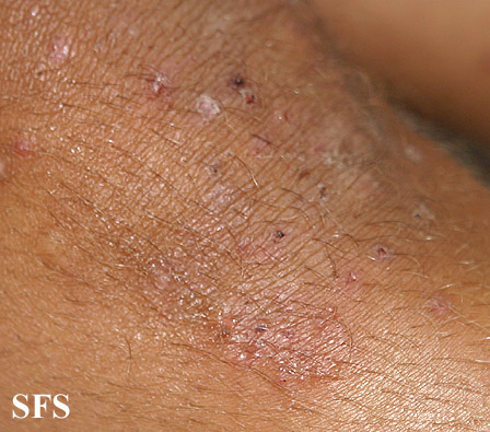 File:Dermatitis herpetiformis36.jpg