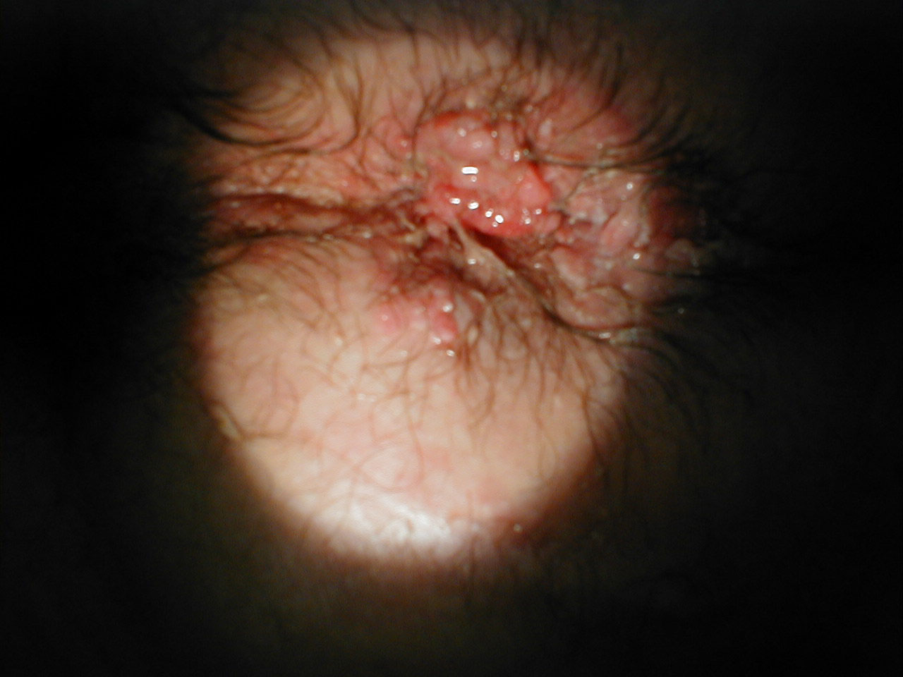 Perianal Condyloma Acuminata: Extensive lesions surrounding anus.