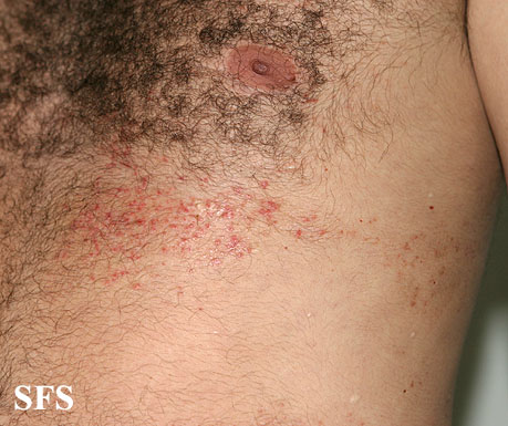 Linear Darier's disease. Adapted from Dermatology Atlas.[1]