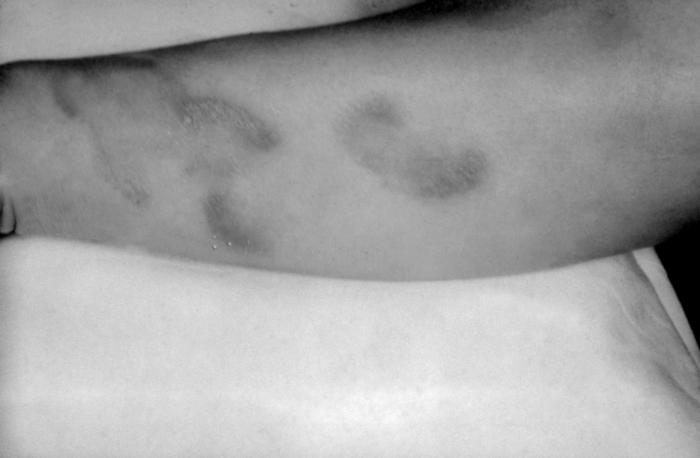 A photograph of a patient with tertiary syphilis depicting gummatous lesions on the volar surface of the right arm. Tertiary syphilis occurs many years after initial untreated primary syphilis. Gummas, or internal tissue granulation, form and result in severe damage to the skin, bone, liver and other bodily organs, or regions. Adapted from CDC