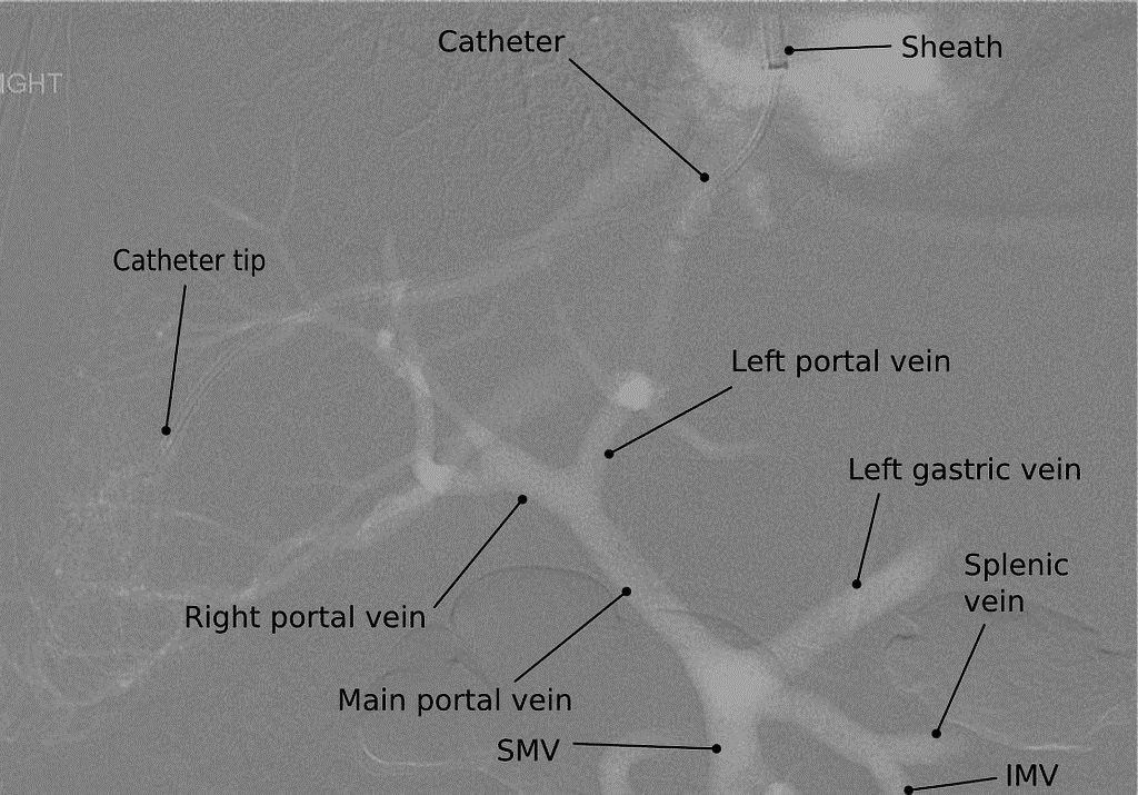 Gastrointestinal varices other imaging findings - wikidoc