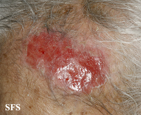 Dermatosis neglecta. Adapted from Dermatology Atlas.[6]