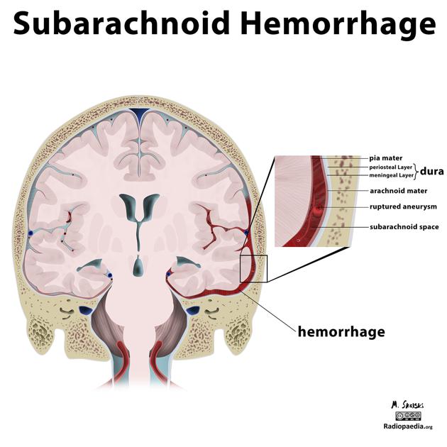 File:Subarachnoid Hemorrhage .jpg