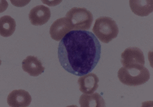 File:Atypical Bcell gif.gif