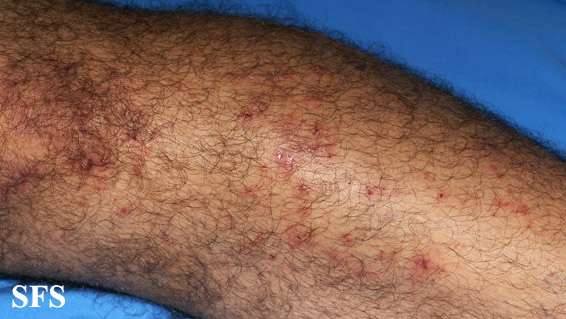File:Dermatitis herpetiformis46.jpg