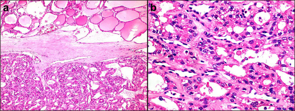 Histology of the encapsulated tumor. (a) Photomicrograph showing an encapsulated tumor composed of cells arranged in microfollicular, glandular and trabecular patterns (hematoxylin and eosin; 100×). (b) High power photomicrograph showing the microfollicles containing inspissated colloid resembling hyaline globules and separated by eosinophilic extracellular hyaline material. (hematoxylin and eosin; 100×).[7]