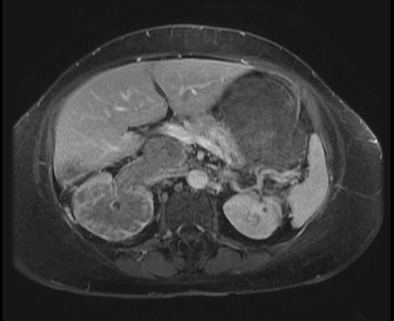 T1 post contrast: Renal cell carcinoma with intravascular extension