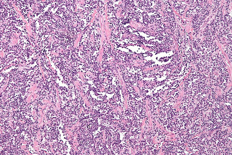 File:800px-Alveolar rhabdomyosarcoma - intermed mag.jpg