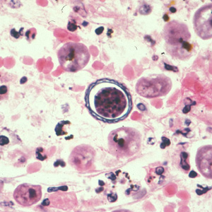 Cyst of Acanthamoeba sp. from brain tissue, stained with hematoxylin and eosin (H&E). Adapted from CDC