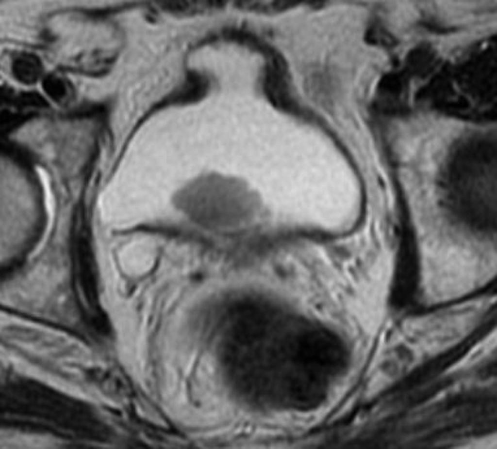 File:Bladder-cancer-invading-the-ureteral-ostium.jpg