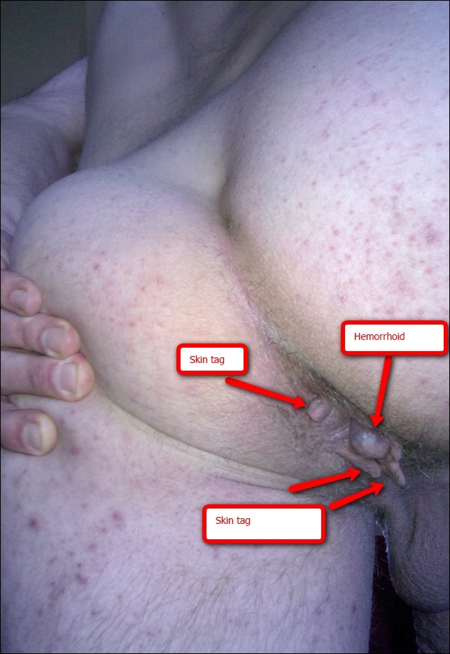 File:Hemorrhoid with skin tags - By Tmalonetn - Own work, CC BY-SA 3.0, httpscommons.wikimedia.orgwindex.phpcurid=10358212.jpg