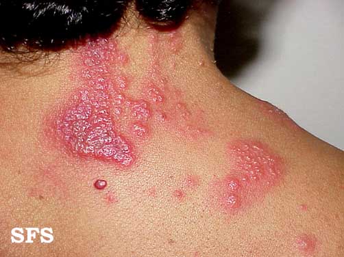 File:Herpes zoster 03.jpeg