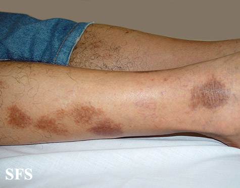 Majocchi’s disease. With permission of Dermatology Atlas<ref name="www.atlasdermatologico.com.br">"Dermatology Atlas".