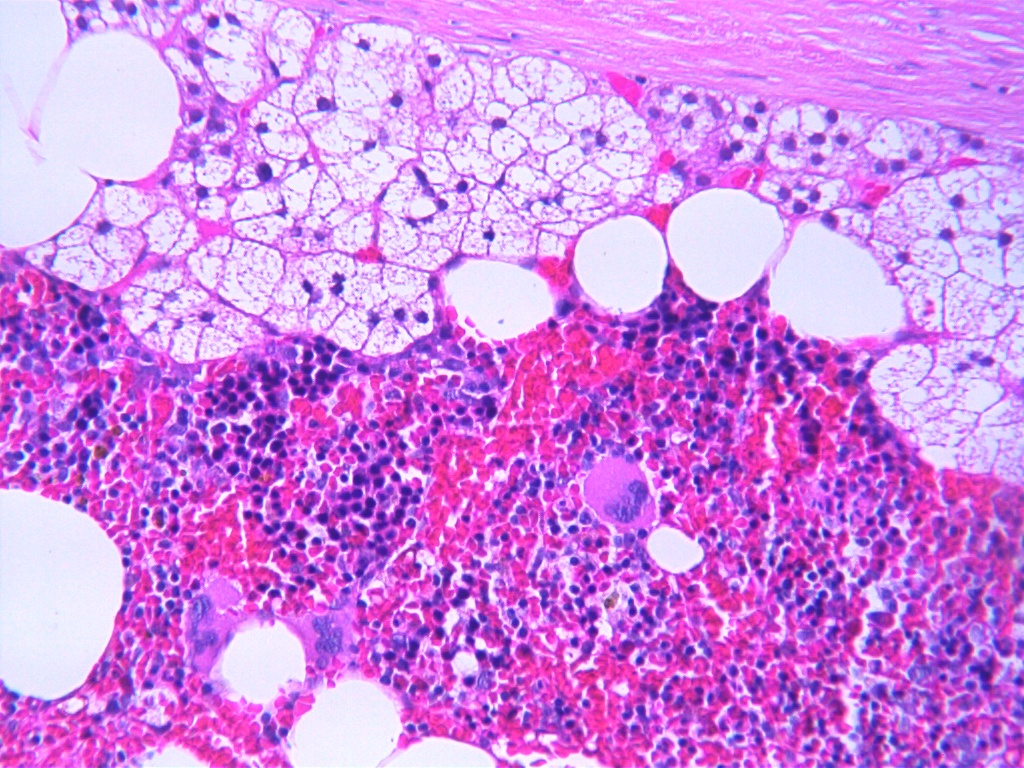 Myelolipoma microscopic picture, source: By Mattopaedia - Own work, CC BY-SA 3.0, https://commons.wikimedia.org/w/index.php?curid=5688142