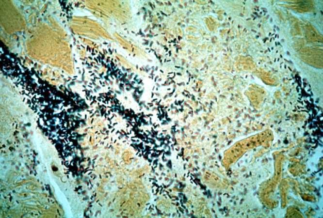This is a high-power photomicrograph of a tissue section stained with a tissue Gram's stain (Brown & Brenn). The Gram-positive bacilli can be seen throughout this tissue section.