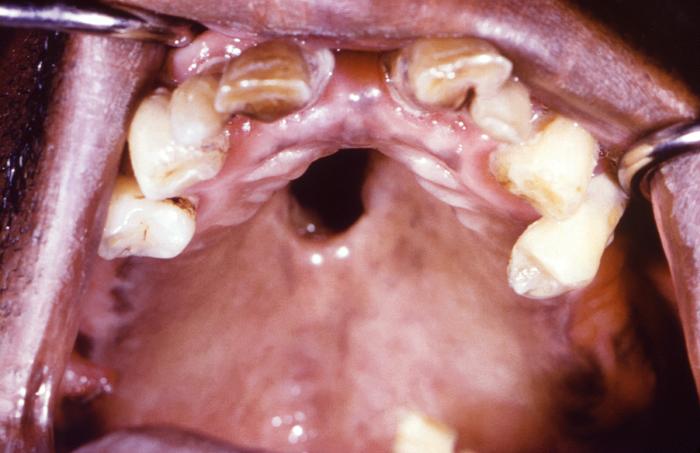 This close-up view demonstrates the interior oral cavity of an elderly African-American male patient, revealing a perforated hard palate due to what was a congenital syphilis infection. At the time of this photograph, the patient was being treated for both active syphilis, and gonorrhea infections. Congenital syphilis, is a condition caused by infection in utero with Treponema pallidum. A wide spectrum of severity exists, and only severe cases are clinically apparent at birth. An infant or child (aged less than 2 years) may have signs such as hepatosplenomegaly, rash, condyloma lata, snuffles, jaundice (nonviral hepatitis), pseudoparalysis, anemia, or edema (nephrotic syndrome and/or malnutrition). An older child may have stigmata (e.g., interstitial keratitis, nerve deafness, anterior bowing of shins, frontal bossing, mulberry molars, Hutchinson teeth, saddle nose, rhagades, or Clutton joints). Adapted from CDC
