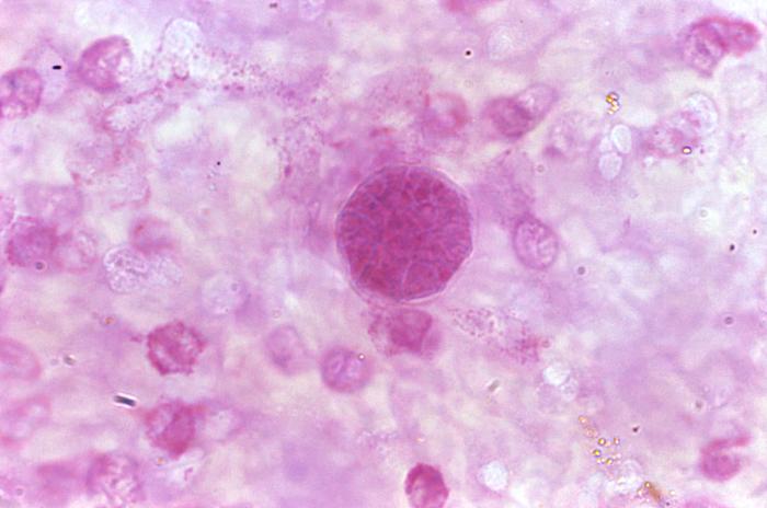 Histopathologic characteristics found within a pus specimen, prepared using periodic acid-Schiff (PAS). Specimen harvested from a skin lesion in a case of cutaneous coccidioidomycosis. From Public Health Image Library (PHIL). [5]