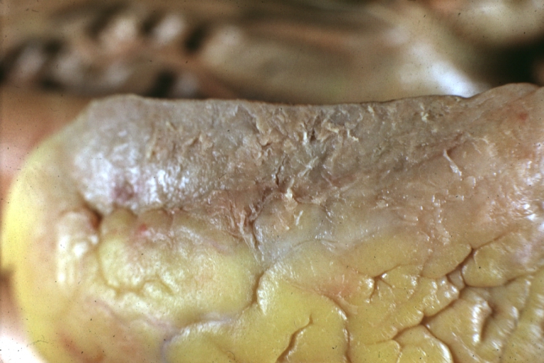 Fibrinous pericarditis: Gross, fixed tissue (note to color changes), a close-up view of fibrin on epicardial surface of heart, a typical example.