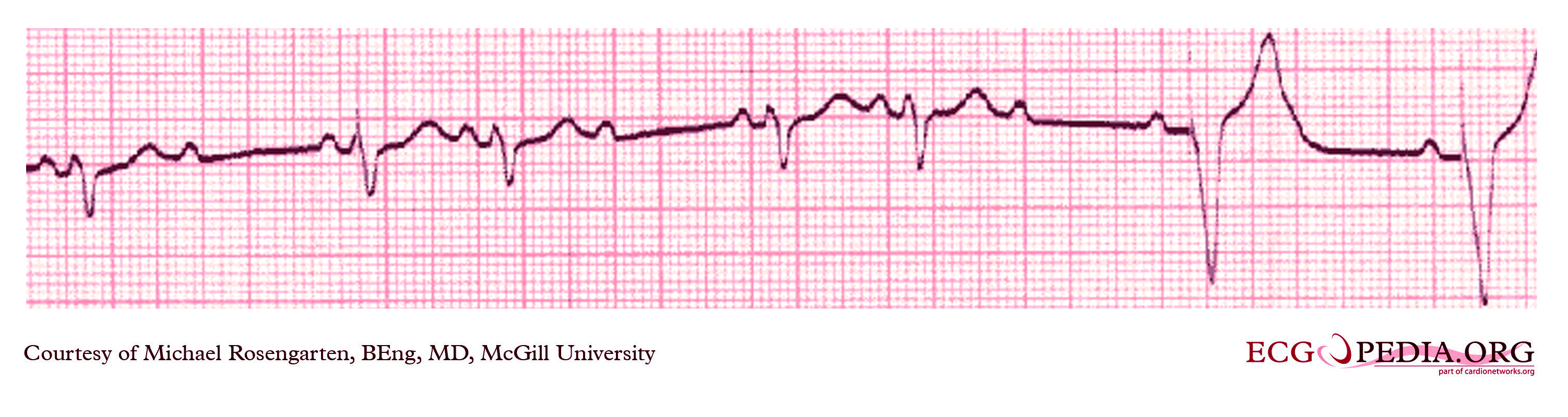 Single chamber pacemaker ecg