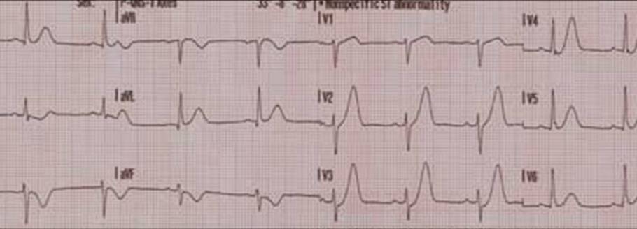 Hyperacute, asymmetrical and broad based T waves in anterior leads; also showing poor R wave progression