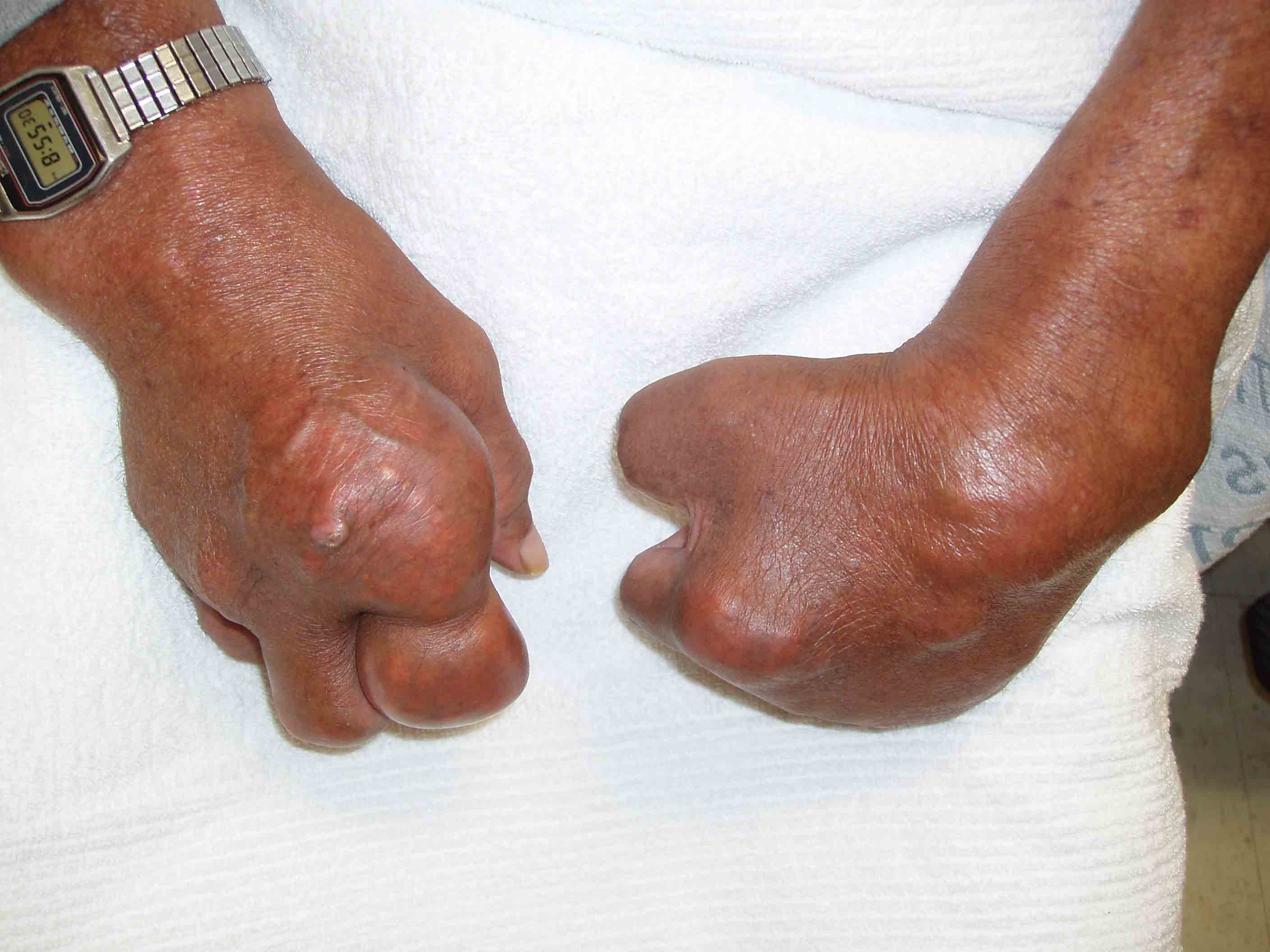 Tophaceous Gout