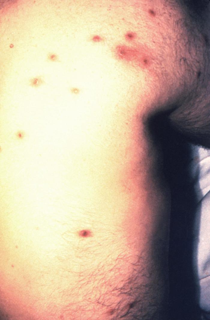 Viewed from the right posterior-oblique view, the male patient depicted here was in bed, in a clinical setting, and had presented with a pancorporeal maculopapular rash, which was initially thought to be a possible case of smallpox, but which later, was diagnosed as herpes simplex. Herpes simplex virus, otherwise known as Herpesvirus hominis is a member of a group of viruses including those which cause oral herpes, i.e., usually HSV-1, and genital herpes, i.e., usually HSV-2. The virus can become disseminated, as was the case here, usually involving patients who are immunocompromised such as in the case of AIDS, or undergoing chemotherapeutic treatment. Adapted from CDC
